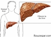 انواع کبد چرب fatty liver 